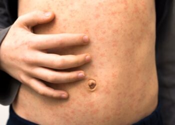 Más de 60 niños infectados en un brote de sarampión en el norte de Londres