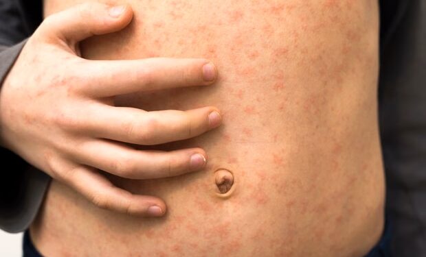 Más de 60 niños infectados en un brote de sarampión en el norte de Londres