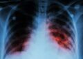 ARGENTINA: La tuberculosis sigue en aumento: los casos crecieron 71,6% desde 2020 y preocupa la mortalidad