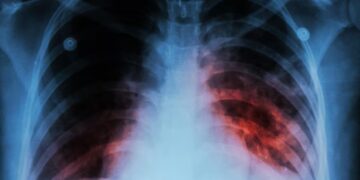 ARGENTINA: La tuberculosis sigue en aumento: los casos crecieron 71,6% desde 2020 y preocupa la mortalidad