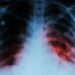 ARGENTINA: La tuberculosis sigue en aumento: los casos crecieron 71,6% desde 2020 y preocupa la mortalidad